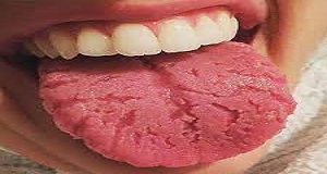 دهان خشک یا زروستومی چیست؟